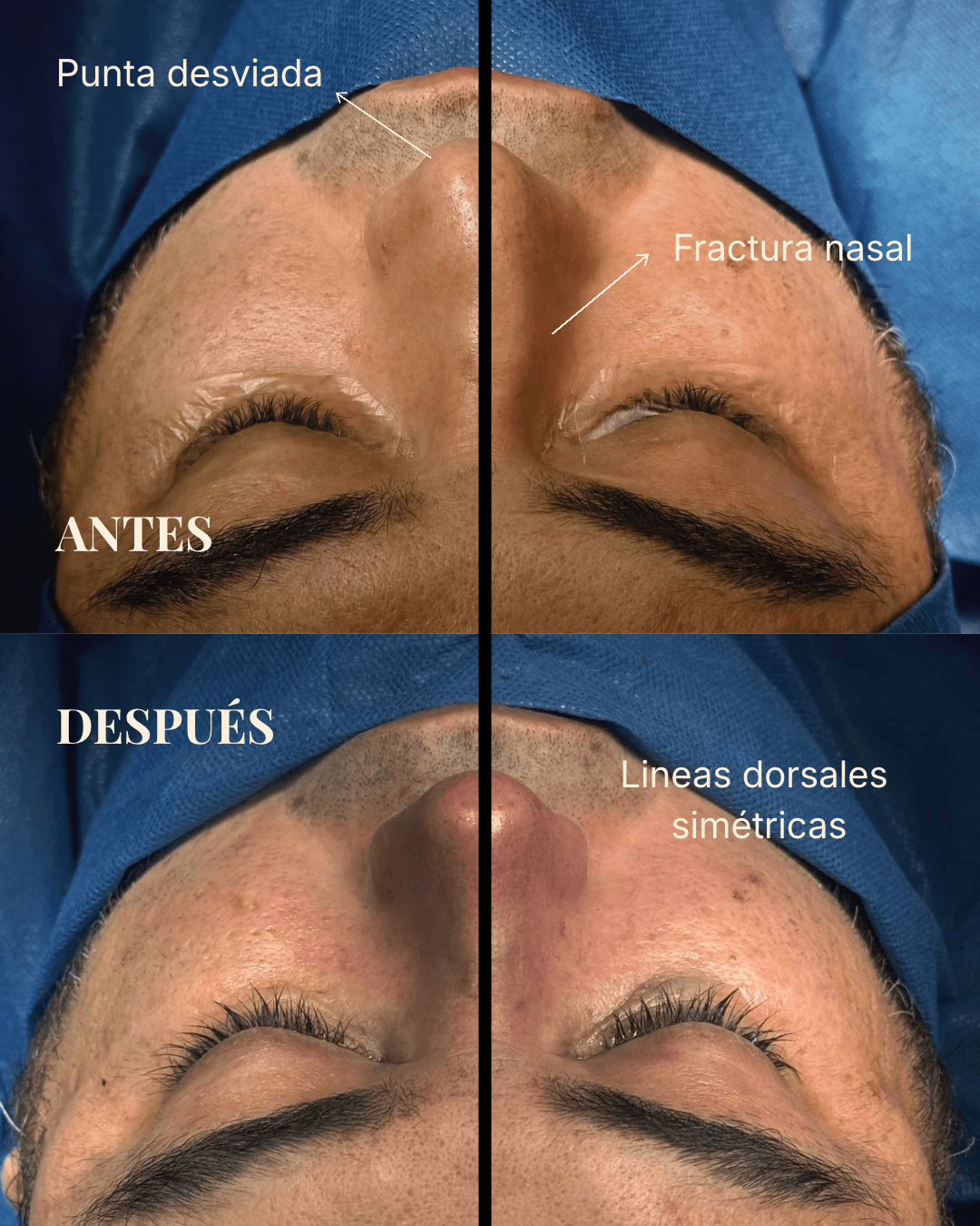 Antes y después de una rinoplastia realizada por la Dra. Luisa Alarcón